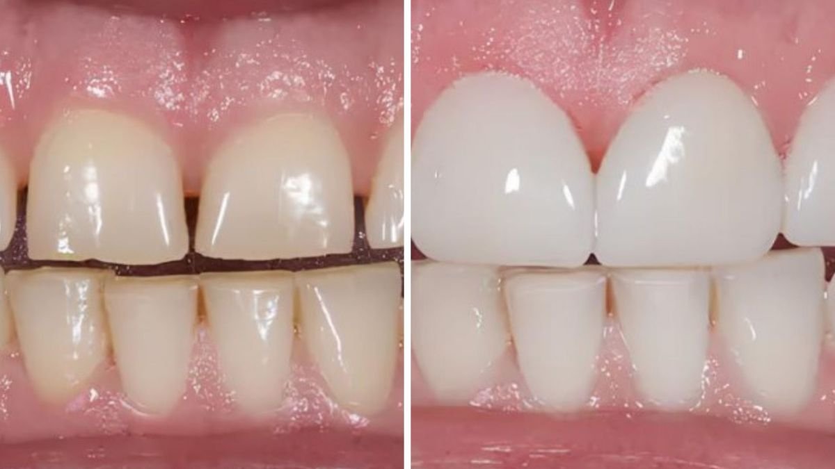 نتائج قبل وبعد الفينير في Smile Centrum – تحول واضح وابتسامة أكثر بياضًا