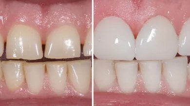 До и после установки виниров в Smile Centrum – заметное преображение улыбки и белые зубы