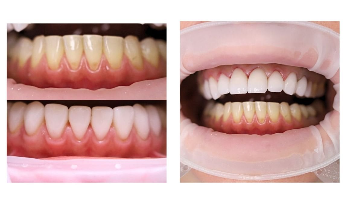 نتائج قبل وبعد الفينير في Smile Centrum – أسنان أكثر بياضًا وابتسامة محسنة