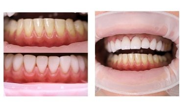 До та після встановлення вініров у Smile Centrum – білі рівні зуби, покращена посмішка