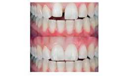 Vorher-nachher-Ergebnis Porzellanveneers bei Smile Centrum – bessere Zahnstellung und Farbe