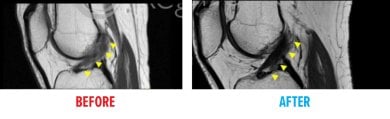 Before and after stem cell therapy result for knee joint at Reviv clínica, MRI comparison