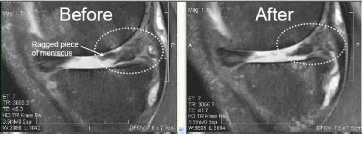 Antes y después de terapia con células madre para artritis en Reviv clínica, mejora de menisco