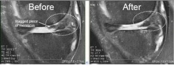 Before and after stem cell therapy for arthritis at Reviv clínica, improved knee meniscus result