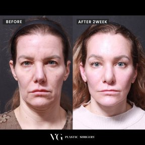 Before and after jaw shaping results at VG Plastic Surgery, visible facial contour improvement