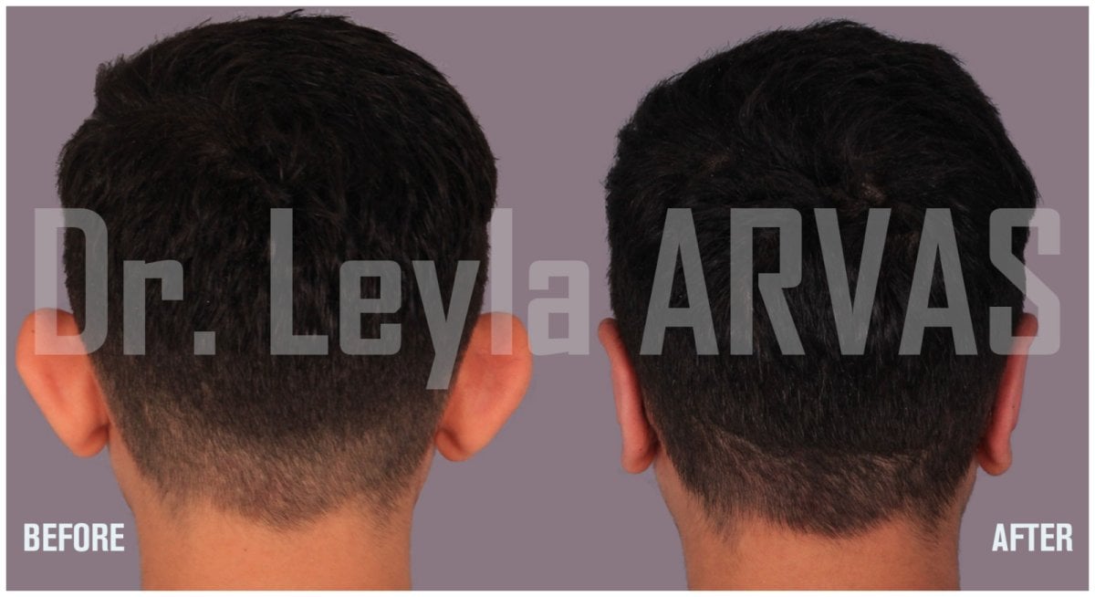 Отопластика до та після в Quartz Hospital – покращена форма і положення вух