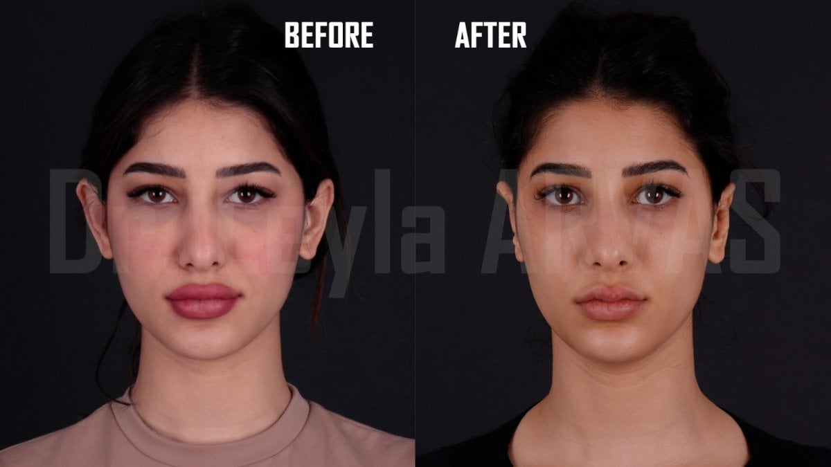 Отопластика до і після в Quartz Hospital – покращена форма та симетрія вух