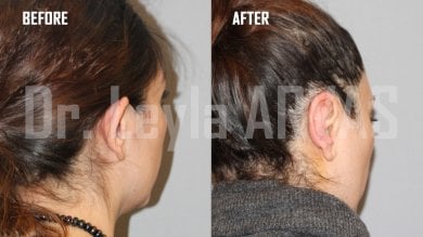 نتائج تجميل الأذن قبل وبعد في Quartz Hospital، إعادة تشكيل الأذن بمظهر طبيعي