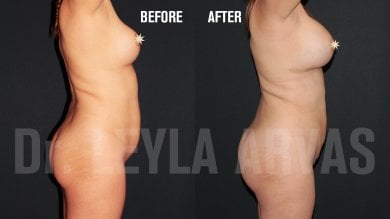 Before and after breast augmentation with fat transfer results at Quartz Hospital