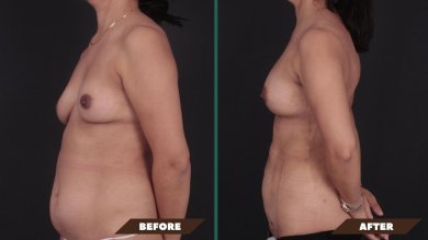 Before and after breast augmentation with fat transfer at Quartz Hospital, visible contour result