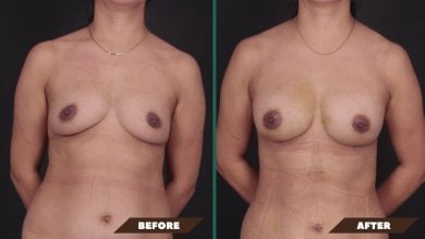 Before and after breast augmentation with fat transfer results at Quartz Hospital