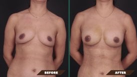 Before and after breast augmentation with fat transfer results at Quartz Hospital