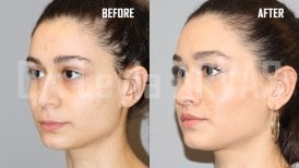 Résultats avant et après lip lift à Quartz Hospital, contour de la lèvre supérieure amélioré