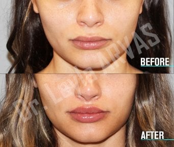 Resultados de lip lift antes y después en Quartz Hospital, mayor contorno y volumen labial
