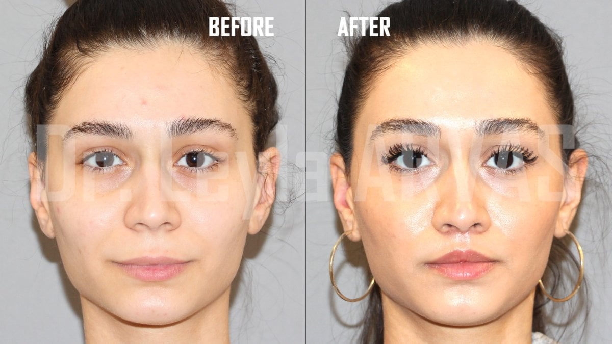 Результати до і після лип-ліфтингу в Quartz Hospital, покращений контур верхньої губи