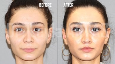 Resultados de lip lift antes y después en Quartz Hospital, mejora del contorno labial superior