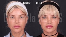 Resultados antes y después de lip lift en Quartz Hospital: contorno superior mejorado
