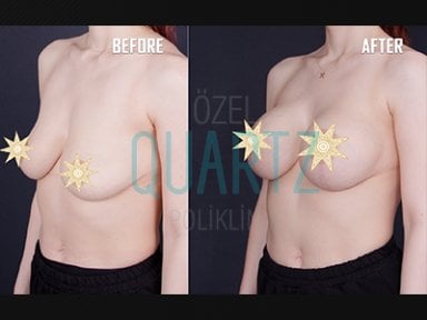 Before and after breast implants with lift results at Quartz Hospital – enhanced breast shape
