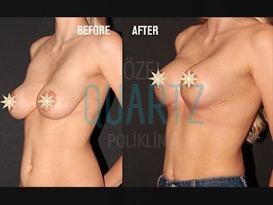Before and after breast implants with lift at Quartz Hospital, enhanced breast contour result