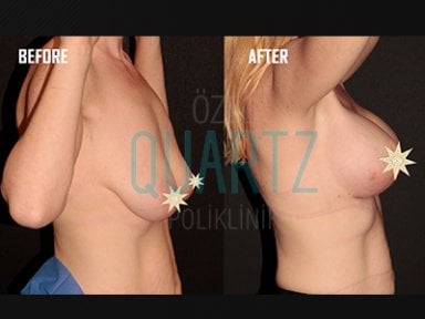Before and after breast implants with lift results at Quartz Hospital, enhanced breast shape