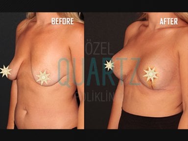 Before and after breast implants with lift results at Quartz Hospital – enhanced breast shape