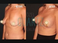 Before and after breast implants with lift results at Quartz Hospital – enhanced breast shape