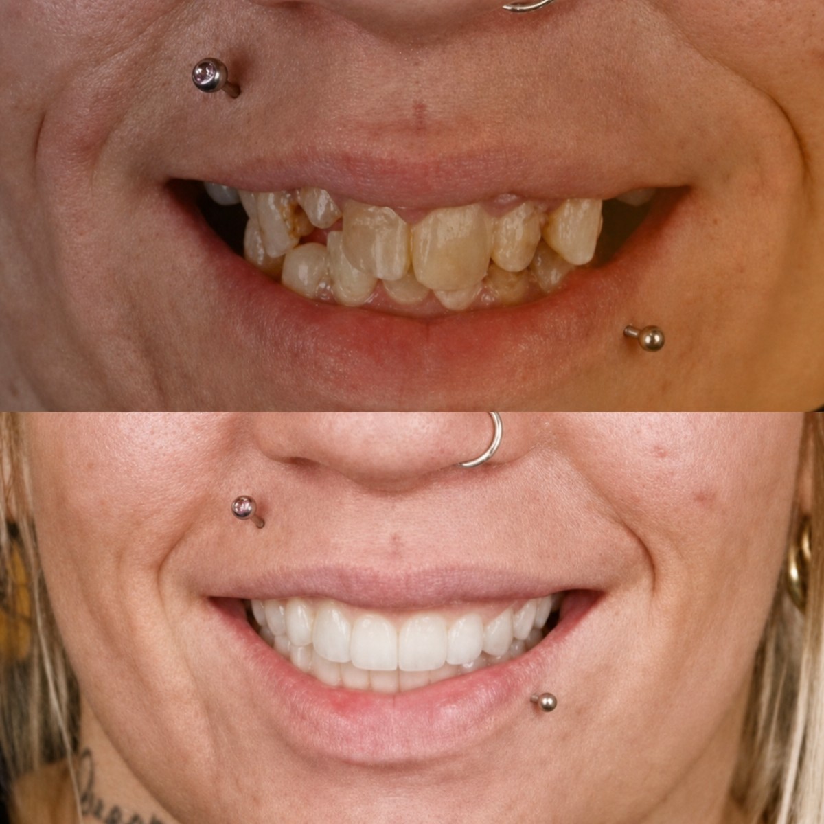 Resultados antes y después de implantes dentales All-on-6 en SmileBox Dental Clinic Thonglor