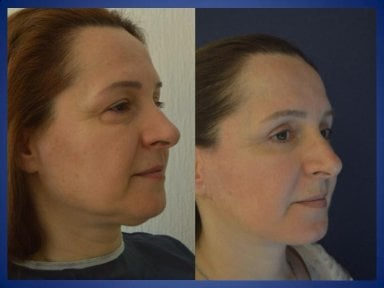 Résultats avant/après lifting du cou à Istanbul Aesthetic Plastic Surgery Center, contour visible