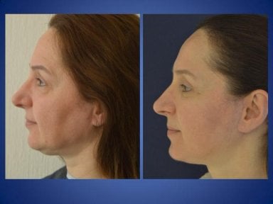 Résultats avant/après lifting du cou à Istanbul Aesthetic Plastic Surgery Center, mâchoire affinée