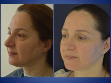 نتائج شد الرقبة قبل وبعد في مركز إسطنبول لجراحة التجميل، تحديد واضح للعنق