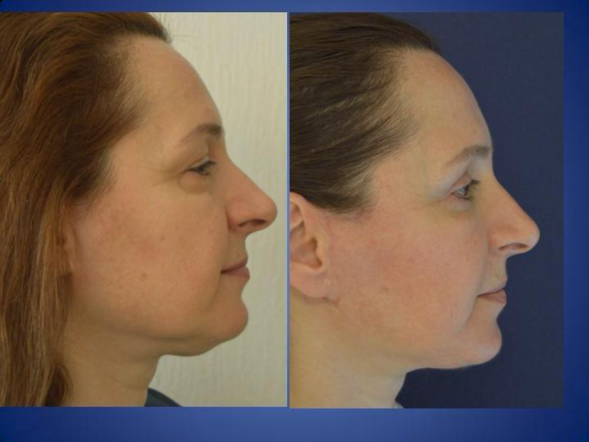 نتائج شد الرقبة قبل وبعد في مركز إسطنبول لجراحة التجميل، خط فك مشدود