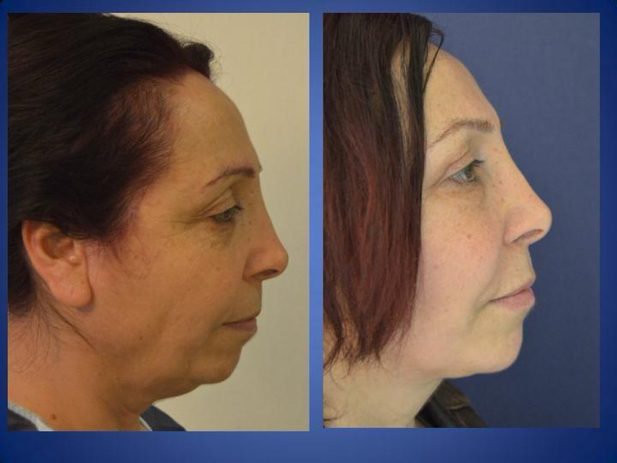 نتائج شد الرقبة قبل وبعد في مركز إسطنبول لجراحة التجميل، تحسين خط الفك