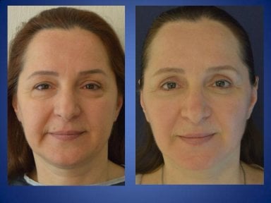 نتائج شد الرقبة قبل وبعد في مركز اسطنبول لجراحة التجميل، تجديد ملحوظ