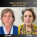 Before and after deep plane face and neck lift results at ID Clinic Bangkok, visible rejuvenation