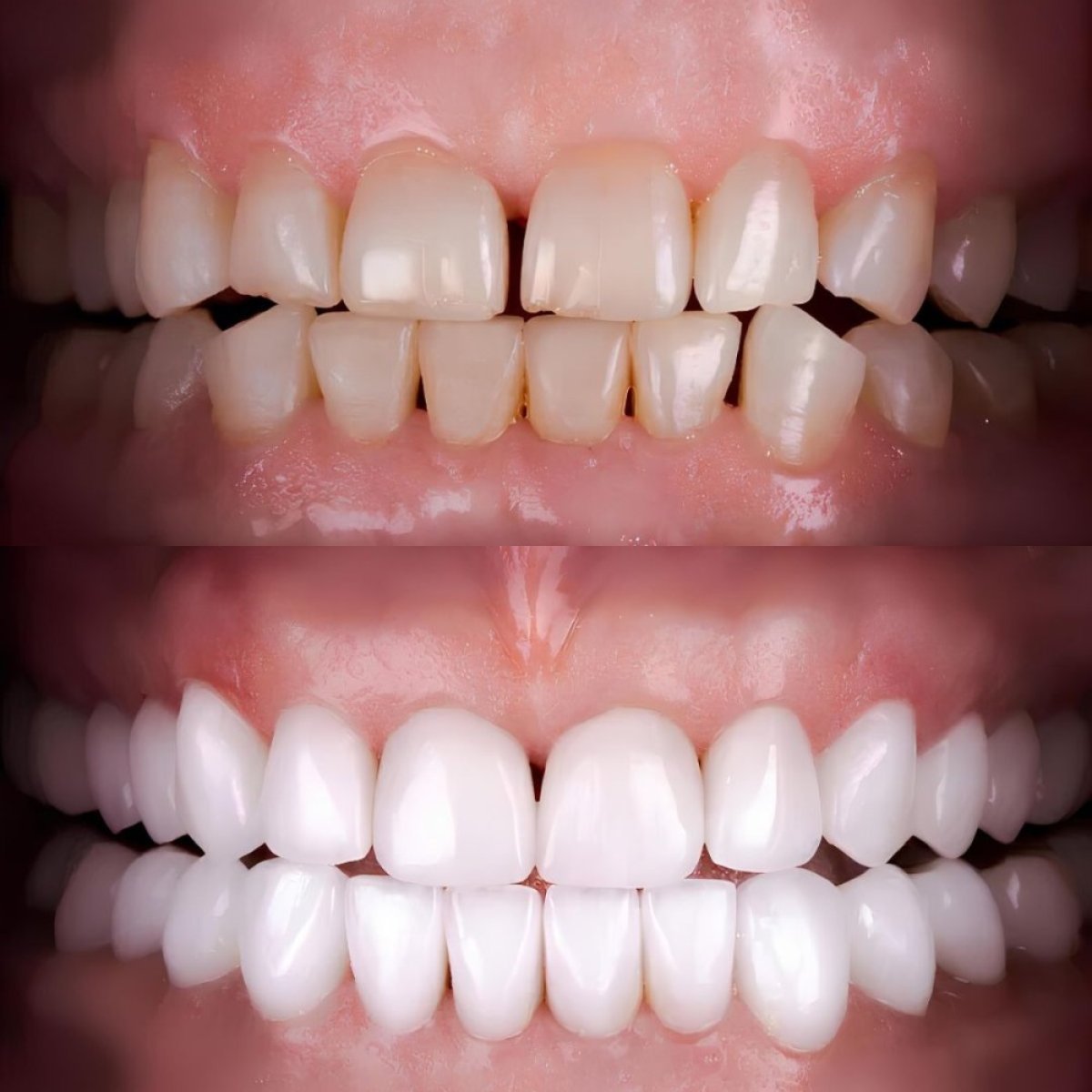 نتائج قبل وبعد الفينير في Smile Centrum – ابتسامة أكثر بياضًا وانتظامًا