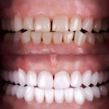До та після встановлення вініров у Smile Centrum – перетворення посмішки, білі рівні зуби