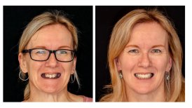 Vorher-nachher-Ergebnisse Kronenverlängerung bei Smile Centrum – verbesserte Zahnästhetik