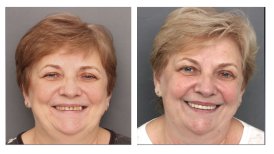 Vorher-nachher-Ergebnis Kronenverlängerung bei Smile Centrum – verbesserte Zahnfleischlinie