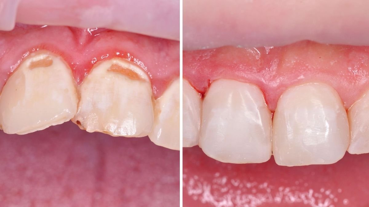 قبل وبعد تطويل التاج في Smile Centrum – تحسين خط اللثة ومظهر الأسنان