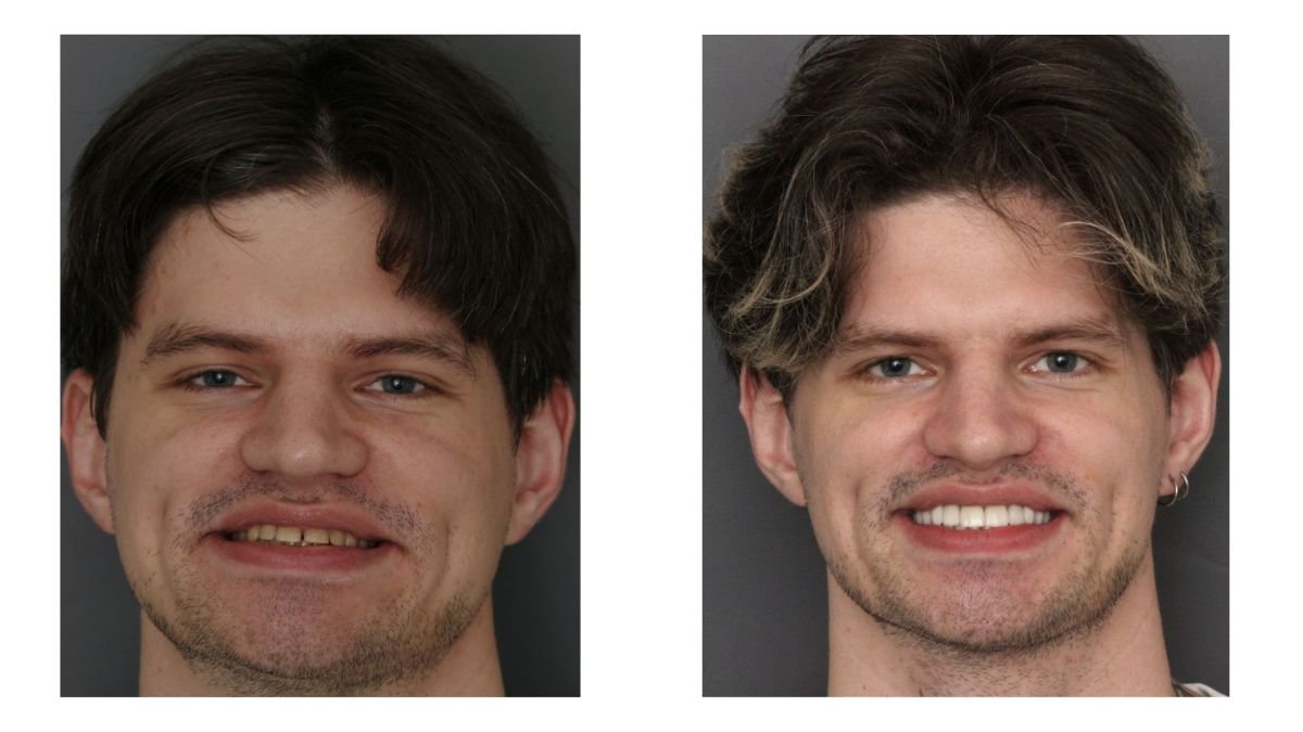 نتيجة قبل وبعد تركيب تاج PFM في Smile Centrum – تحسين جمالية الابتسامة
