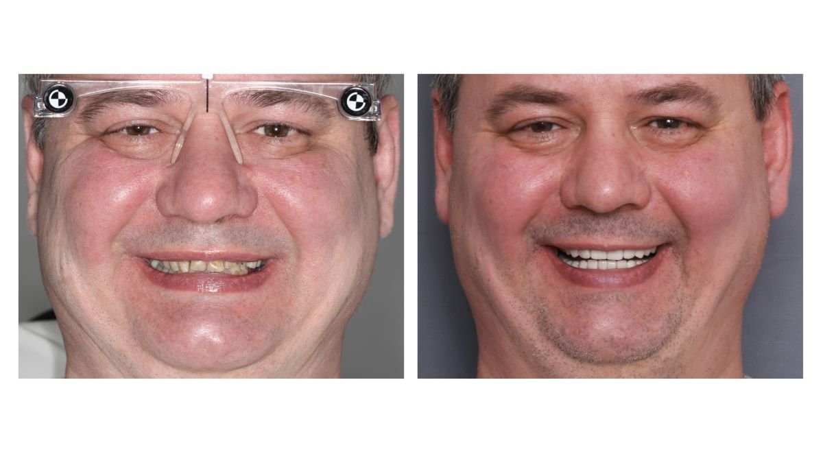 نتائج قبل وبعد تركيب تاج PFM في Smile Centrum، تحسين جمالية الابتسامة