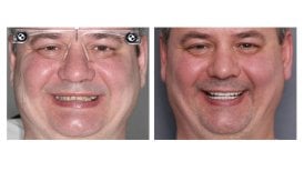 نتائج قبل وبعد تركيب تاج PFM في Smile Centrum، تحسين جمالية الابتسامة