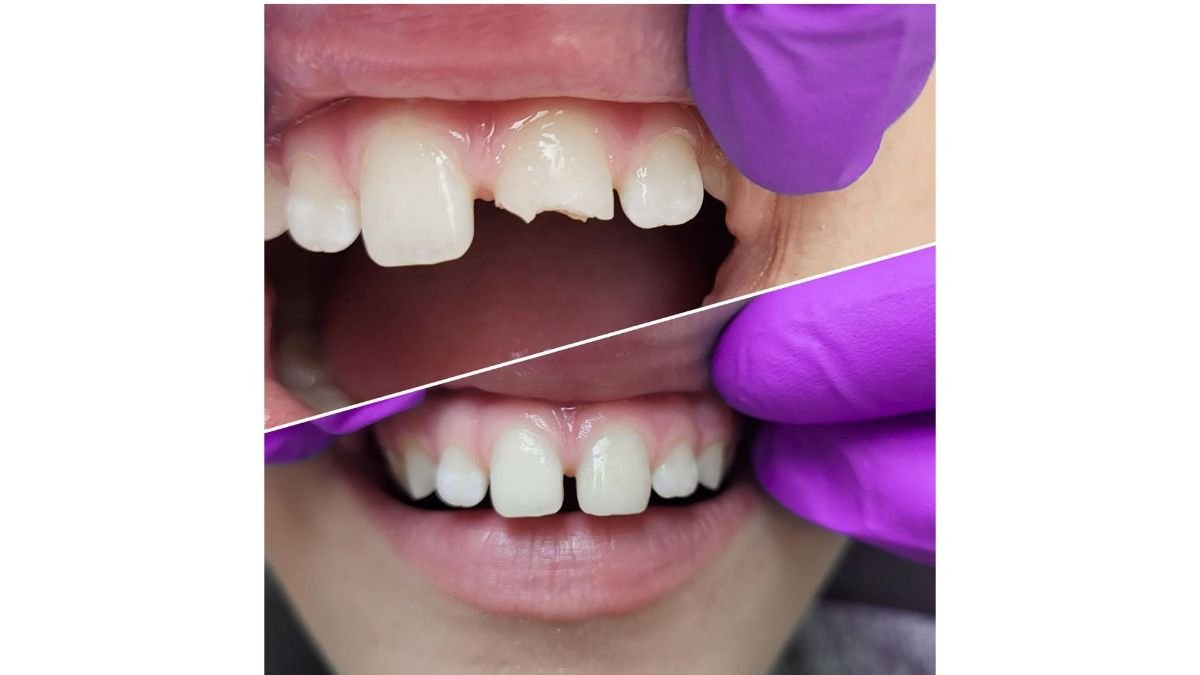 نتيجة قبل وبعد تركيب تاج PFM في Smile Centrum، ترميم الأسنان الأمامية