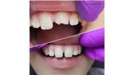 نتيجة قبل وبعد تركيب تاج PFM في Smile Centrum، ترميم الأسنان الأمامية