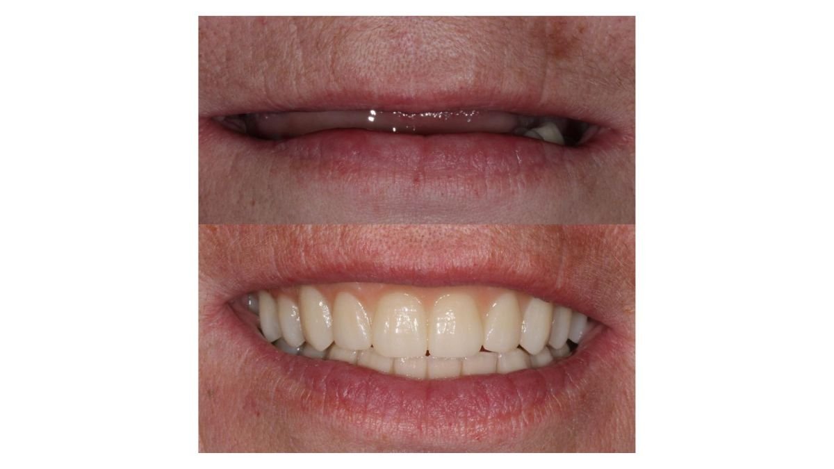 نتائج قبل وبعد تركيب تيجان PFM في Smile Centrum، تحسين مظهر الابتسامة