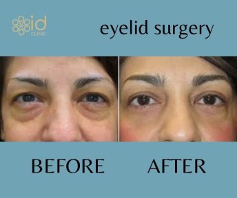 Before and after upper and lower eyelid surgery results at ID Clinic Bangkok, rejuvenated eyes