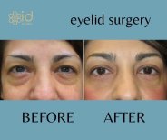Before and after upper and lower eyelid surgery results at ID Clinic Bangkok, rejuvenated eyes