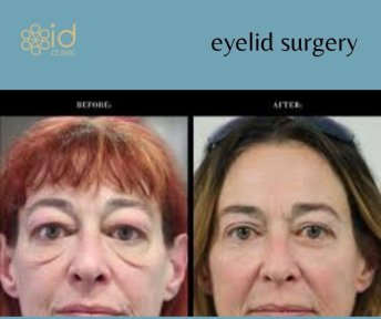 Before and after upper and lower eyelid surgery results at ID Clinic Bangkok