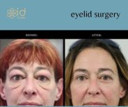 Before and after upper and lower eyelid surgery results at ID Clinic Bangkok