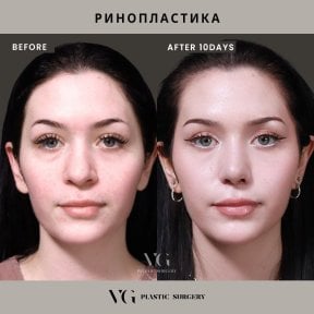 Before and after rhinoplasty results at VG Plastic Surgery, nose reshaping visible after 10 days